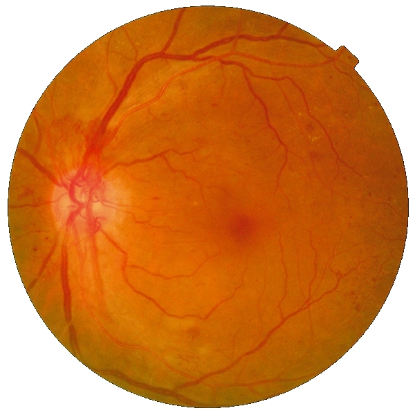 Rétinopathie Diabétique