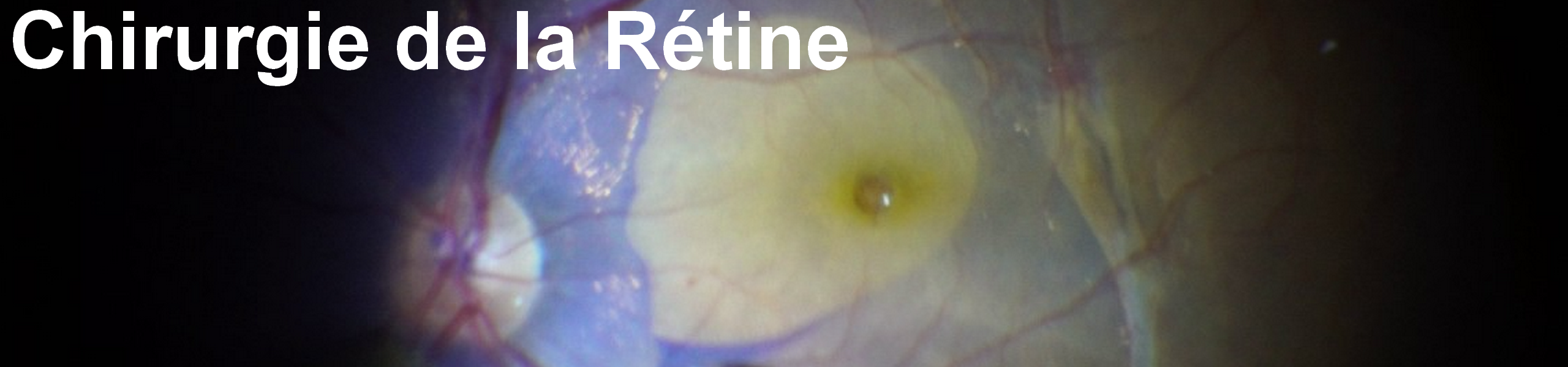 Chirurgie Rétine